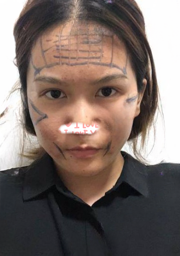 自体脂肪胶