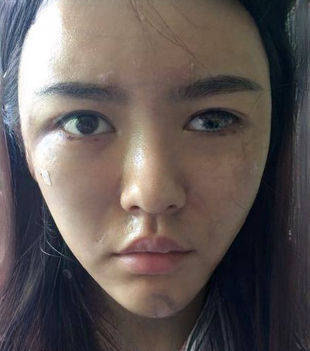 自体脂肪胶