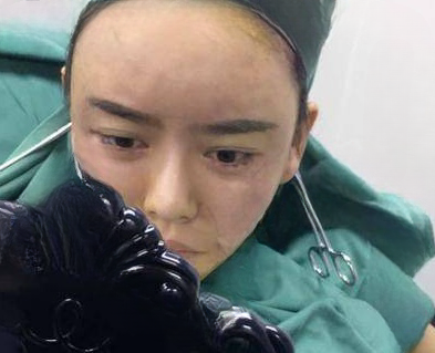 自体脂肪胶