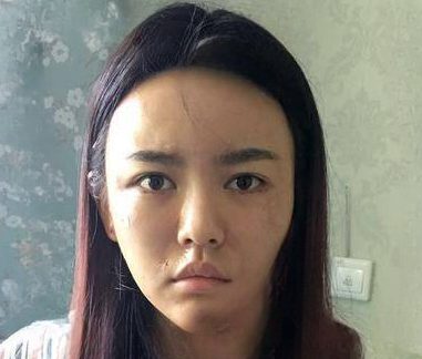 自体脂肪胶