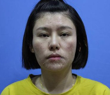自体脂肪胶