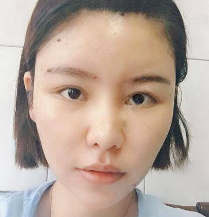 自体脂肪胶
