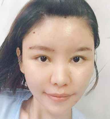 自体脂肪胶