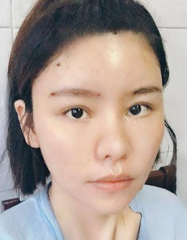 自体脂肪胶