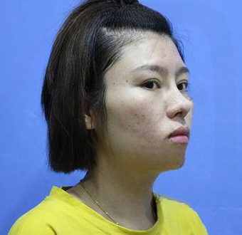 自体脂肪胶