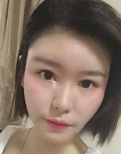 自体脂肪胶