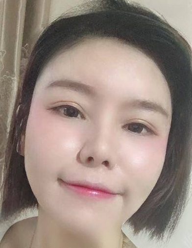 自体脂肪胶