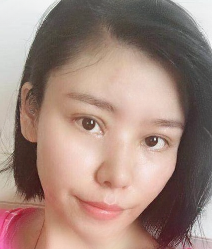 自体脂肪胶