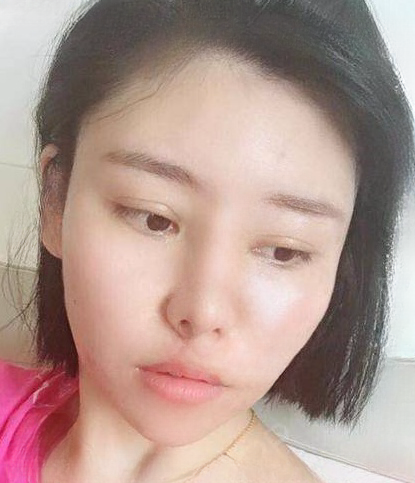 自体脂肪胶