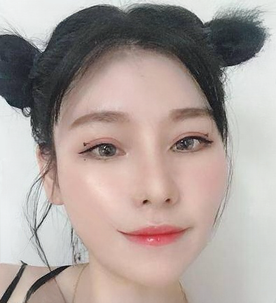 自体脂肪胶