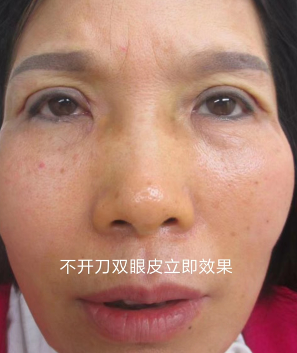 双眼皮手术