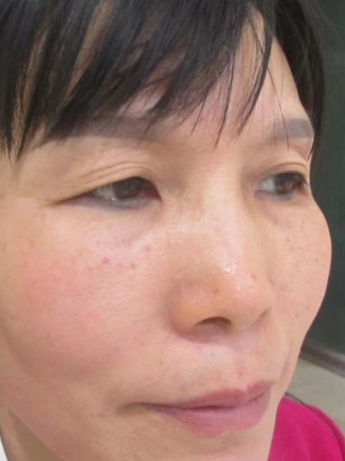 双眼皮手术