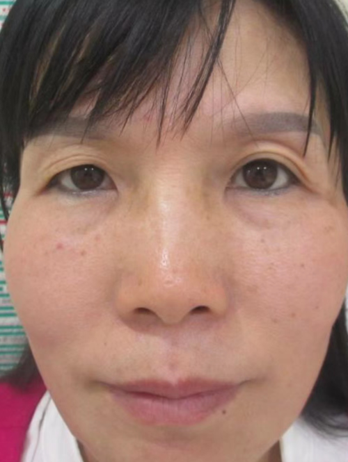 双眼皮手术