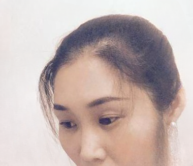 去眼袋手术