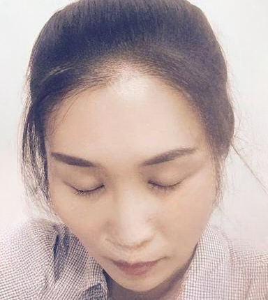 去眼袋手术