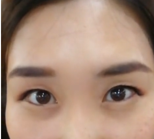 去眼袋手术