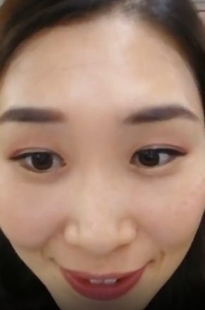 去眼袋手术