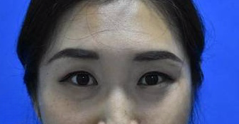 去眼袋手术