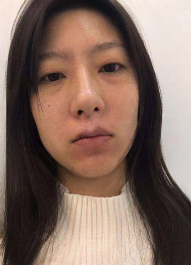 去眼袋手术