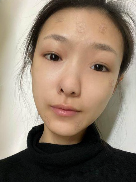 自体脂肪胶