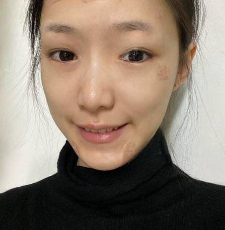自体脂肪胶
