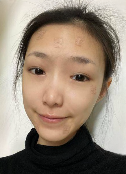 自体脂肪胶