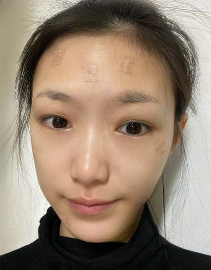 自体脂肪胶