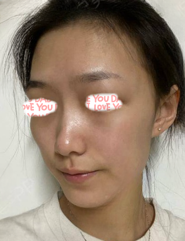 自体脂肪胶