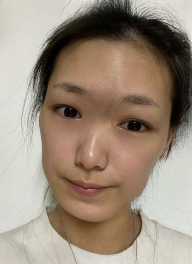 自体脂肪胶