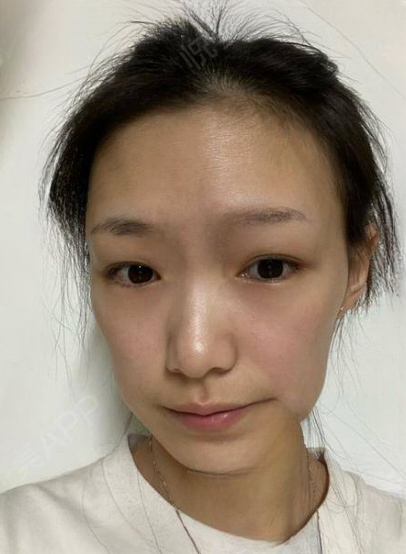 自体脂肪胶