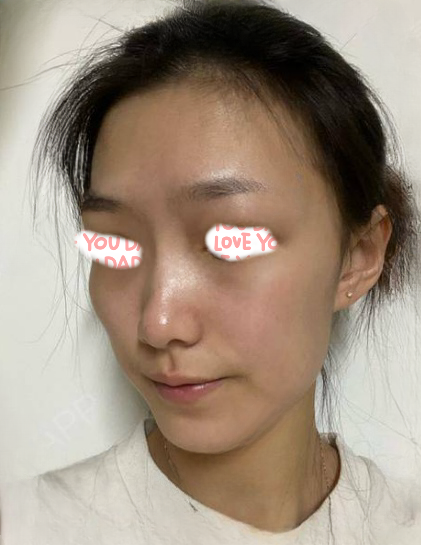 自体脂肪胶