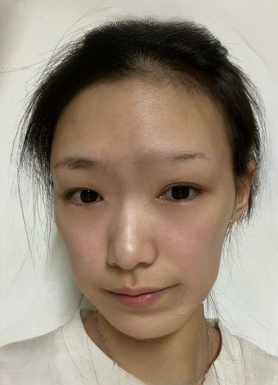 自体脂肪胶