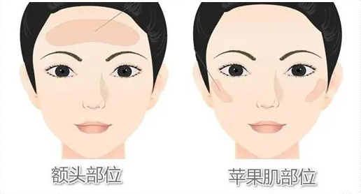 自体脂肪胶