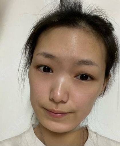 自体脂肪胶