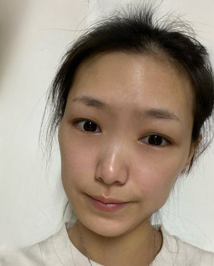 自体脂肪胶
