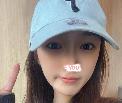 自体脂肪胶