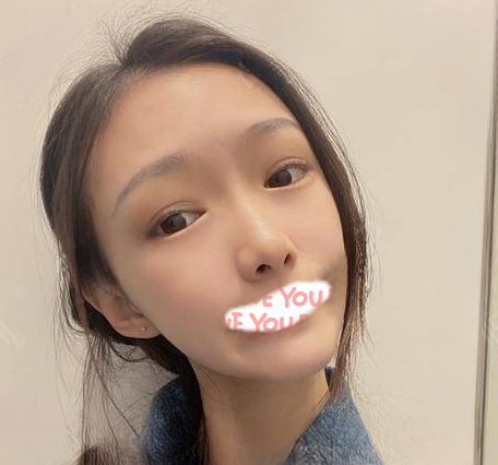自体脂肪胶