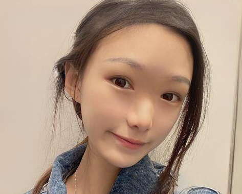 自体脂肪胶