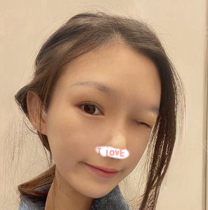 自体脂肪胶