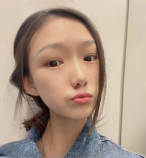 自体脂肪胶