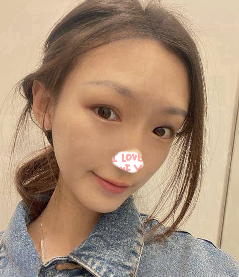 自体脂肪胶