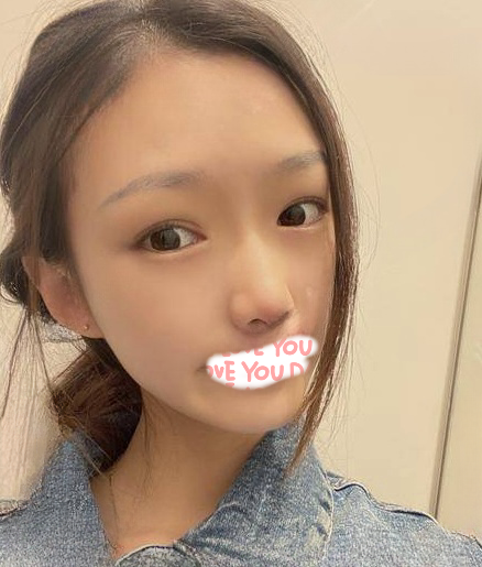 自体脂肪胶