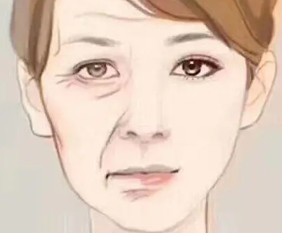 自体脂肪胶