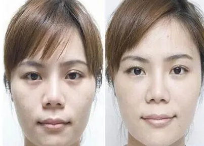 自体脂肪胶