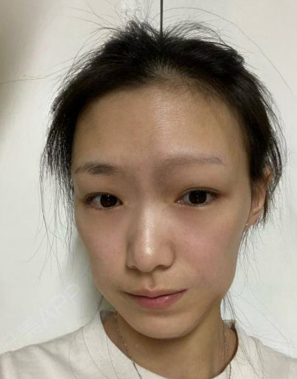 自体脂肪胶