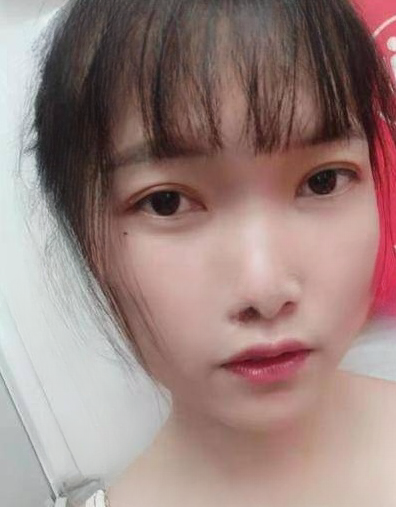 去眼袋手术