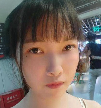 去眼袋手术