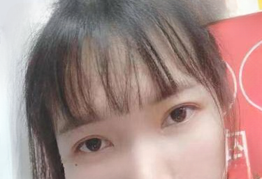 去眼袋手术