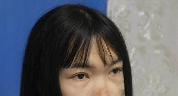 去眼袋手术