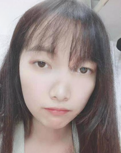 去眼袋手术